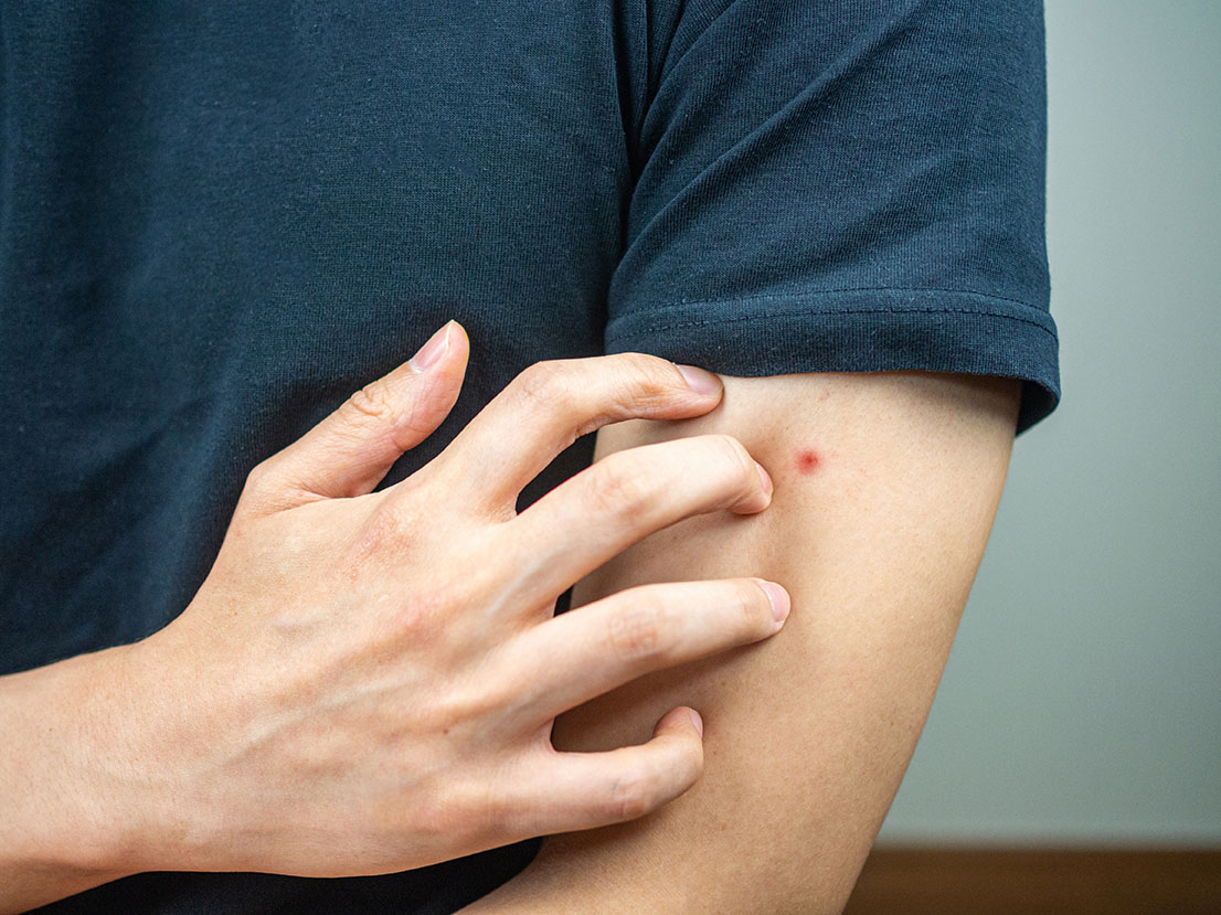 Comment se débarrasser d'un bouton de punaise de lit après une piqûre ?